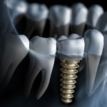 http://drashokdentistree.com/wp-content/uploads/2016/11/dental-implants-150x150.jpg