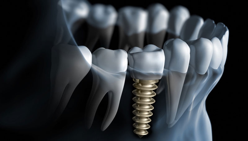 //drashokdentistree.com/wp-content/uploads/2016/11/dental-implants.jpg